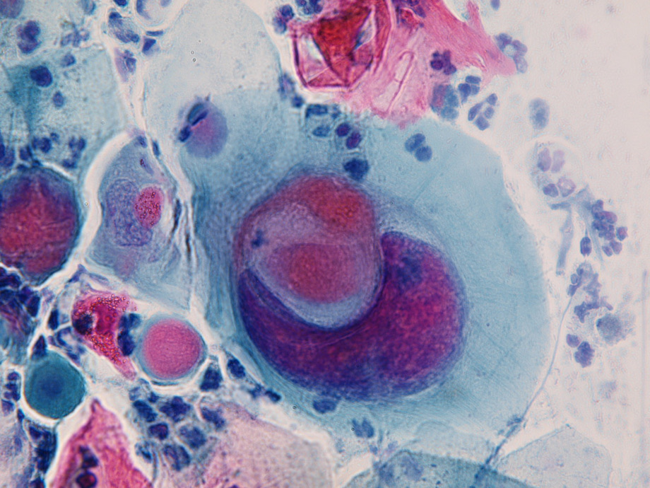 spinocelulární karcinom